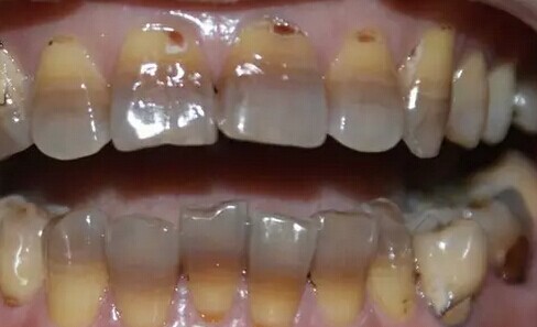1,什么是四环素牙: 四环素牙指在牙发育矿化期,服用的四环素族药物