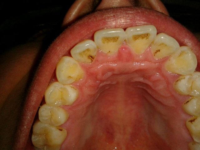 烟渍牙是怎么形成的?