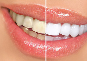 黄牙对我们有哪些影响？又有哪些食物可以抑制黄牙呢？